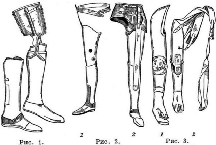 Протезування кінцівок тазостегнового колінного суглоба