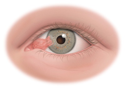 Pterygium Eye