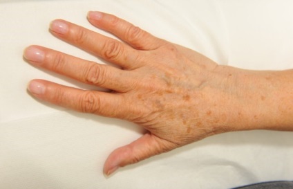 Spoturi pe pielea cauzei, diagnostic, tratament - vii sănătoși