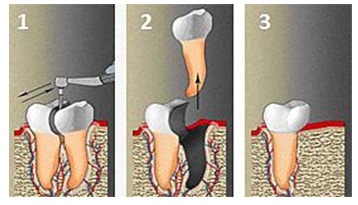 Refacerea vârfului rădăcinii dintelui, hemisecția, operațiile de conservare a dinților