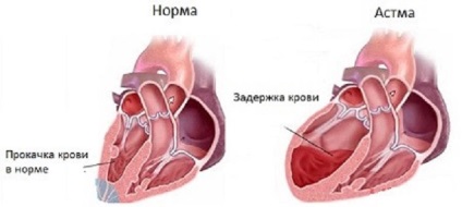 серцева астма