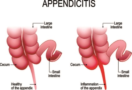 Simptomele apendicitei la adulți