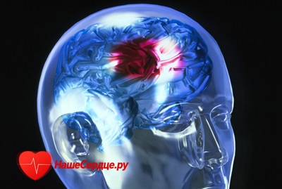 Simptomele și primele semne de accident vascular cerebral