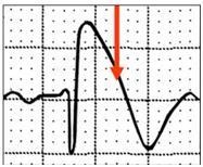 Sindrom brugada