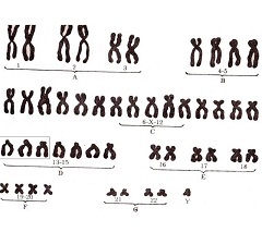 Sindromul Patau - cauze, diagnostic, tratament