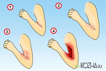 Gradul de semne de arsură, simptome, cum se identifică