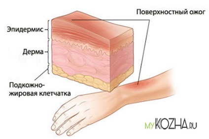 Ступені опіків ознаки, симптоми, як визначити