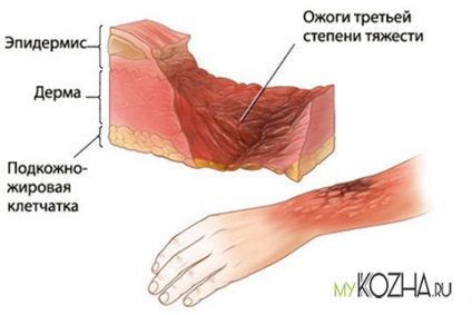 Ступені опіків ознаки, симптоми, як визначити