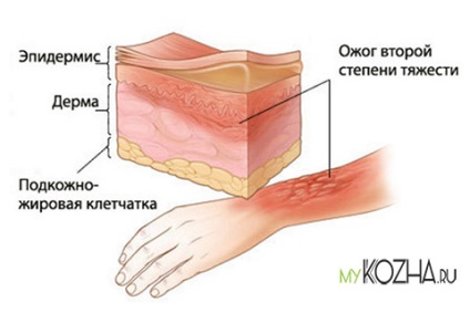 Gradul de semne de arsură, simptome, cum se identifică