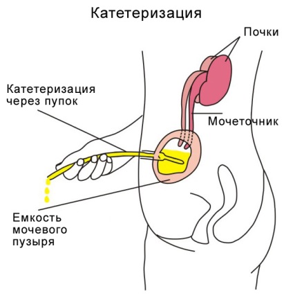 Stomatos vezicii urinare Caracteristici și sfaturi pentru Nursing