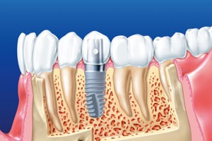 Implantarea dentară a costurilor de dinți, complicații, contraindicații