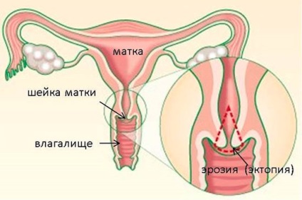 Lumanari de la eroziunea cervicală, contraindicații