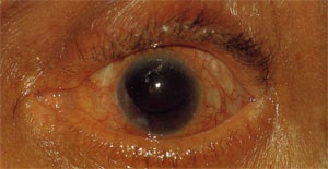 Toxoplasmoza ochiului, tratamentul acestuia