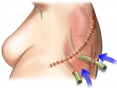 Thoracic chirurg - o profesie pentru ași reali!