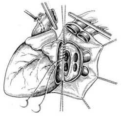 Transplantul de cord la câini - transplant de inimă într-un experiment - transplant de inimă -