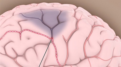 Afectarea ischemică tranzitorie (afectarea tranzitorie a circulației cerebrale)