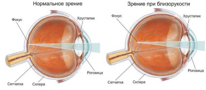 Exerciții pentru ochi cu miopie (miopie)