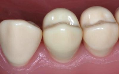 Îngrijirea dinților și molarilor copiilor