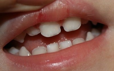 Догляд за молочними і корінними зубами дітей правила і особливості