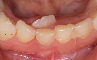 Îngrijirea dinților și molarilor copiilor