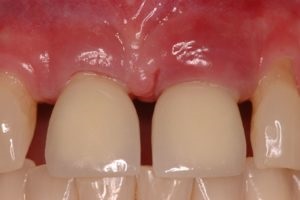 Догляд за зубними імплантами після імплантації зубів