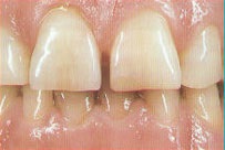 Види протезування - стоматологія-Хейхе - лікування зубів в Хейхе, китаї