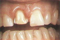 Tipuri de proteze - stomatologie - Heihe - tratament dentar în Heihe, China