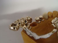 Típusai protézis - Dental-Kheikhe - fogászati ​​kezelés Kheikhe, kína