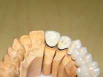 Tipuri de proteze - stomatologie - Heihe - tratament dentar în Heihe, China