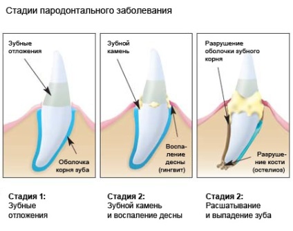 Tipuri de boală a gingiilor