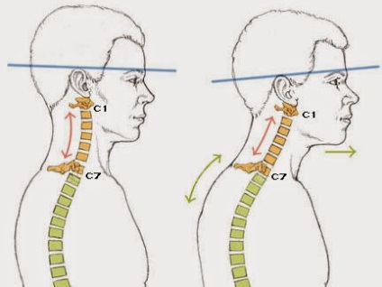 Kiegyenesítése lordosis a nyaki gerinc