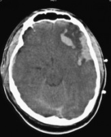 Hematom intracranian - cauze și semne de hematom intracranian