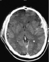 Hematom intracranian - cauze și semne de hematom intracranian