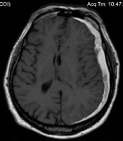 Hematom intracranian - cauze și semne de hematom intracranian