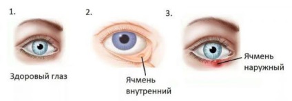 Ячмінь на оці лікування в домашніх умовах народними засобами і медикаментозно при вагітності