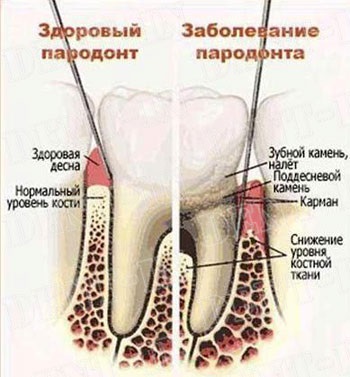 Boala gingiilor, gingivitei, parodontitei, parodontitei - de către medic d
