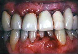 Gum betegség fogínygyulladás, periodontitis, a periodontális betegség - doktorstom g