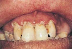 Boala gingiilor, gingivitei, parodontitei, parodontitei - de către medic d