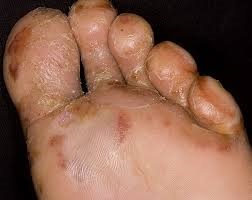 Este eczema invazivă?