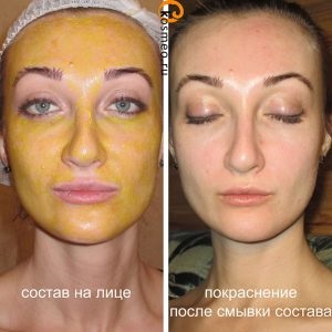 Sfat peeling galben retinoic, fotografie înainte și după