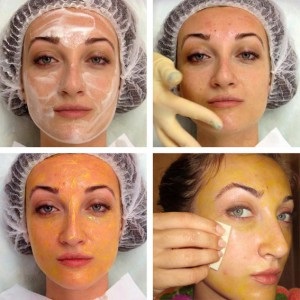 Sfat peeling galben retinoic, fotografie înainte și după