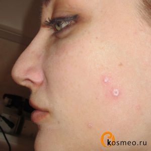 Sárga retinsav hámlani kezd, adjunk hozzá egy fénykép előtt és után (peeling) Sárga retinsav peeling felülvizsgálat, fotók előtt és után