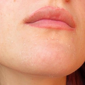 Sárga retinsav hámlani kezd, adjunk hozzá egy fénykép előtt és után (utána) Sárga retinsav peeling felülvizsgálat, fotók előtt és után