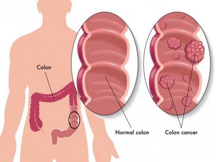 10 Semne ale cancerului de colon!