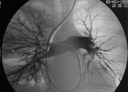 Algoritmi pentru diagnosticarea și tratamentul embolismului pulmonar, tehnologii moderne, oficial