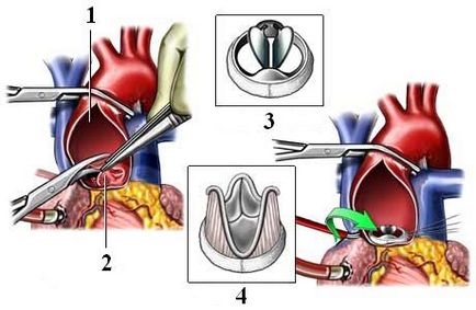 Stenoza aortică - Informații despre simptome