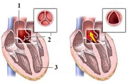 Stenoza aortică - Informații despre simptome