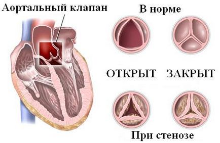 Stenoza aortică - Informații despre simptome