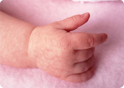 Az atópiás dermatitis ( „Mátrix” kapcsolati zóna) atópiás dermatitis