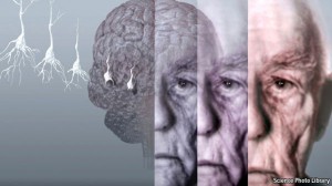 Boala Alzheimer este o afecțiune care-ți îndepărtează mintea